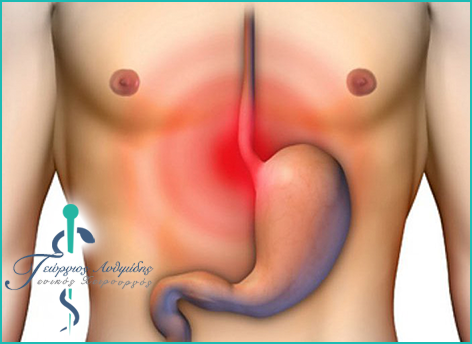 Achalasia