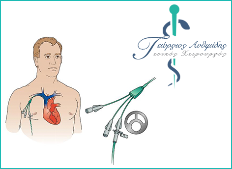 Catheters for Chemotherapy