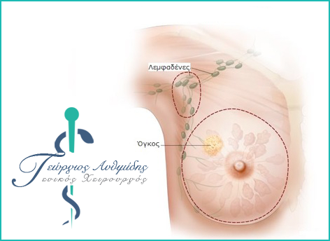 Sentinel Lymph Node
