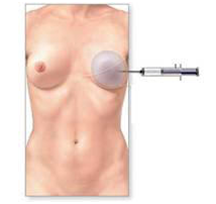 breast cancer