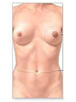 breast cancer treatment