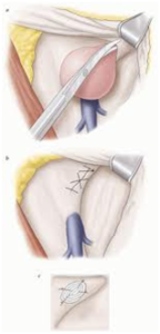 femoral hernia
