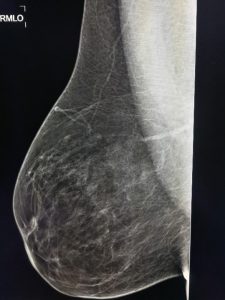 πυκνότητα μαστού