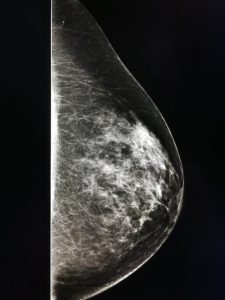 πυκνότητα μαστού