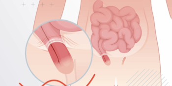 Αν έχω βουβωνοκήλη τι πρέπει να αποφεύγω;