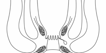 Θεραπεία κονδυλωμάτων πρωκτού