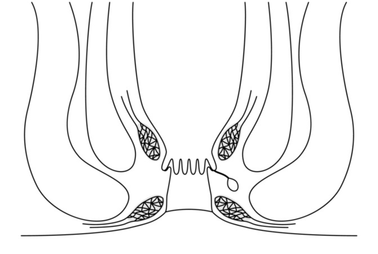 Θεραπεία κονδυλωμάτων πρωκτού
